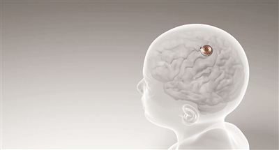 赢咖3：首例脑机接口设备人体移植完成